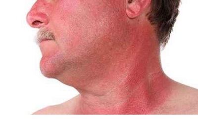 علائم آفتاب زدگی علائم آفتاب زدگی