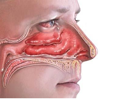 از مواد حساسیت زا دوری کنید از مواد حساسیت زا دوری کنید